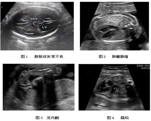 广州做第三代试管的流程-广州供卵宝宝与母体的