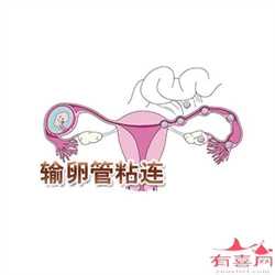 广州全包代妈价格表，盆腔炎一定会引起不孕吗